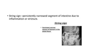 • String sign –persistently narrowed segment of intestine due to
inflammation or stricture.
 