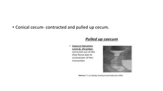 • Conical cecum- contracted and pulled up cecum.
 
