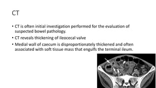 CT
• CT is often initial investigation performed for the evaluation of
suspected bowel pathology.
• CT reveals thickening of ileocecal valve
• Medial wall of caecum is disproportionately thickened and often
associated with soft tissue mass that engulfs the terminal ileum.
 