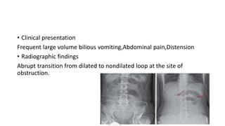 • Clinical presentation
Frequent large volume bilious vomiting,Abdominal pain,Distension
• Radiographic findings
Abrupt transition from dilated to nondilated loop at the site of
obstruction.
 