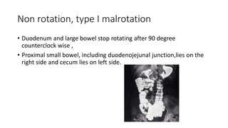 Non rotation, type I malrotation
• Duodenum and large bowel stop rotating after 90 degree
counterclock wise ,
• Proximal small bowel, including duodenojejunal junction,lies on the
right side and cecum lies on left side.
 