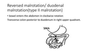 Reversed malrotation/ duodenal
malrotation(type II malrotation)
• bowel enters the abdomen in clockwise rotation
Transverse colon-posterior to duodenum in right upper quadrant.
 