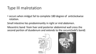 Type III malrotation
• occurs when midgut fail to complete 180 degree of anticlockwise
rotation.
Small intestine lies predominantly in right or mid abdomen.
Mesentric band from liver and posterior abdominal wall cross the
second portion of duodenum and extends to the cecum(ladd’s band)
 