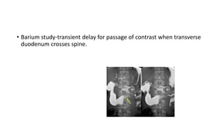 • Barium study-transient delay for passage of contrast when transverse
duodenum crosses spine.
 