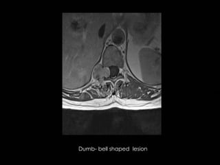 Radiology spinal cord tumors classification | PPTX