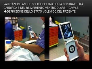 VALUTAZIONE ANCHE SOLO ISPETTIVA DELLA CONTRATTILITÀ
CARDIACA E DEL REIMPIMENTO VENTRICOLARE – CAVALE
DEFINIZIONE DELLO STATO VOLEMICO DEL PAZIENTE

 