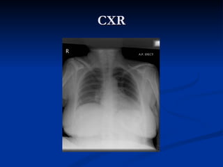 CXR 