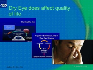 Dry Eye does affect quality of life Making Dry Eyes Wet 