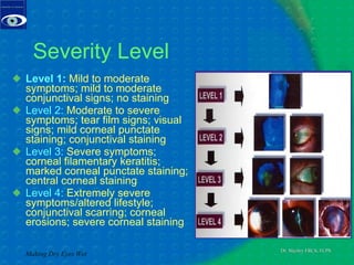 Severity Level Level 1:  Mild to moderate symptoms; mild to moderate conjunctival signs; no staining  Level 2:  Moderate to severe symptoms; tear film signs; visual signs; mild corneal punctate staining; conjunctival staining  Level 3:  Severe symptoms; corneal filamentary keratitis; marked corneal punctate staining; central corneal staining  Level 4:  Extremely severe symptoms/altered lifestyle; conjunctival scarring; corneal erosions; severe corneal staining  Making Dry Eyes Wet 