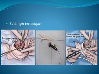 Sialoendoscopy – a novel minimally invasive diagnostic | PPTX