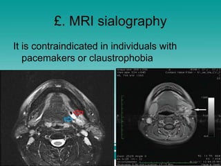 £. MRI sialography
It is contraindicated in individuals with
pacemakers or claustrophobia
 