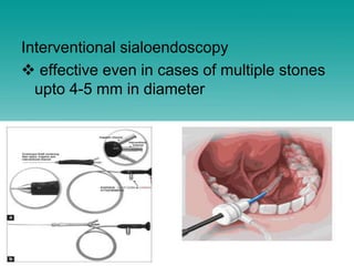 Interventional sialoendoscopy
 effective even in cases of multiple stones
upto 4-5 mm in diameter
 