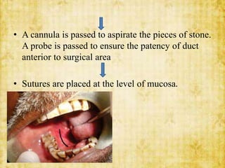 • A cannula is passed to aspirate the pieces of stone.
A probe is passed to ensure the patency of duct
anterior to surgical area
• Sutures are placed at the level of mucosa.
 