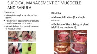 Marsupialization Small Ranula Comprehensive Overview of Salivary Gland Obstruction: Causes, Diagnosis ...