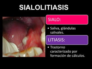 SIALO:
• Saliva, glándulas
salivales.
LITIASIS:
• Trastorno
caracterizado por
formación de cálculos.
SIALOLITIASIS
 