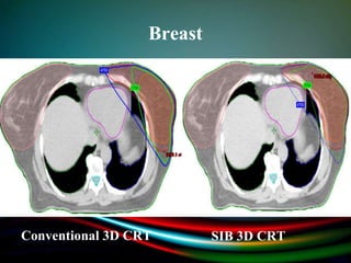 Breast
Conventional 3D CRT SIB 3D CRT
 