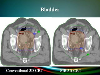 Bladder
Conventional 3D CRT SIB 3D CRT
 