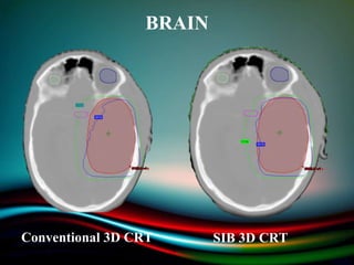 BRAIN
Conventional 3D CRT SIB 3D CRT
 