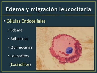 • Células Endoteliales
• Edema
• Adhesinas
• Quimiocinas
• Leucocitos
(Eosinófilos)
 