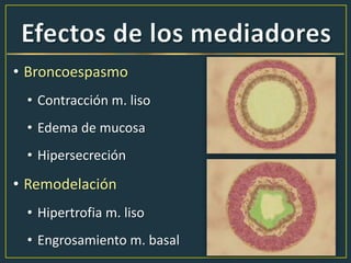 • Broncoespasmo
• Contracción m. liso
• Edema de mucosa
• Hipersecreción
• Remodelación
• Hipertrofia m. liso
• Engrosamiento m. basal
 