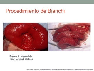 Procedimiento de Bianchi
Segmento yeyunal de
15cm longitud dilatado
http://www.sccp.org.co/plantilas/Libro%20SCCP/Lexias/gastro/intestino%20corto/intestino%20corto.htm
 