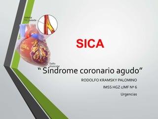SICA
“ Síndrome coronario agudo”
RODOLFO KRAMSKY PALOMINO
IMSS HGZ c/MF Nº 6
Urgencias
 