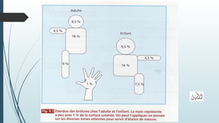 Brûlures: gravité surface
 