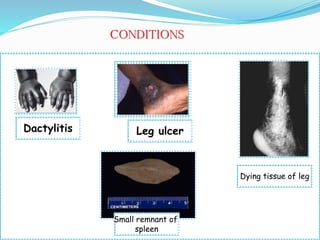 Dactylitis
Dying tissue of leg
Leg ulcer
Small remnant of
spleen
CONDITIONS
 