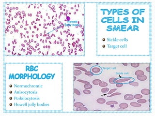 Sickle cells
Target cell
Normochromic
Anisocytosis
Poikilocytosis
Howell jolly bodies
Sickle cell
Target cell
Howell
jolly body
 