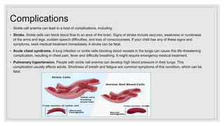 Complications
◦ Sickle cell anemia can lead to a host of complications, including:
• Stroke. Sickle cells can block blood flow to an area of the brain. Signs of stroke include seizures, weakness or numbness
of the arms and legs, sudden speech difficulties, and loss of consciousness. If your child has any of these signs and
symptoms, seek medical treatment immediately. A stroke can be fatal.
• Acute chest syndrome. A lung infection or sickle cells blocking blood vessels in the lungs can cause this life-threatening
complication, resulting in chest pain, fever and difficulty breathing. It might require emergency medical treatment.
• Pulmonary hypertension. People with sickle cell anemia can develop high blood pressure in their lungs. This
complication usually affects adults. Shortness of breath and fatigue are common symptoms of this condition, which can be
fatal.
 
