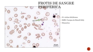  S= celulas falciformes
 HJB= Cuerpos de Howell-Jolly
 Dianocitos
 