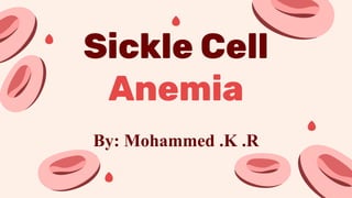 Sickle Cell
Anemia
By: Mohammed .K .R
 