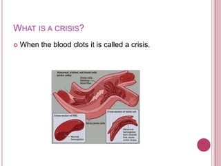 What is a crisis?When the blood clots it is called a crisis.