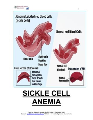 1

SICKLE CELL
ANEMIA
Notes on sickle cell anemia…By Dr. Ashish V. Jawarkar M.D.
Contact – pathologybasics@gmail.com Website – www.pathologybasics.wix.com/notes

 