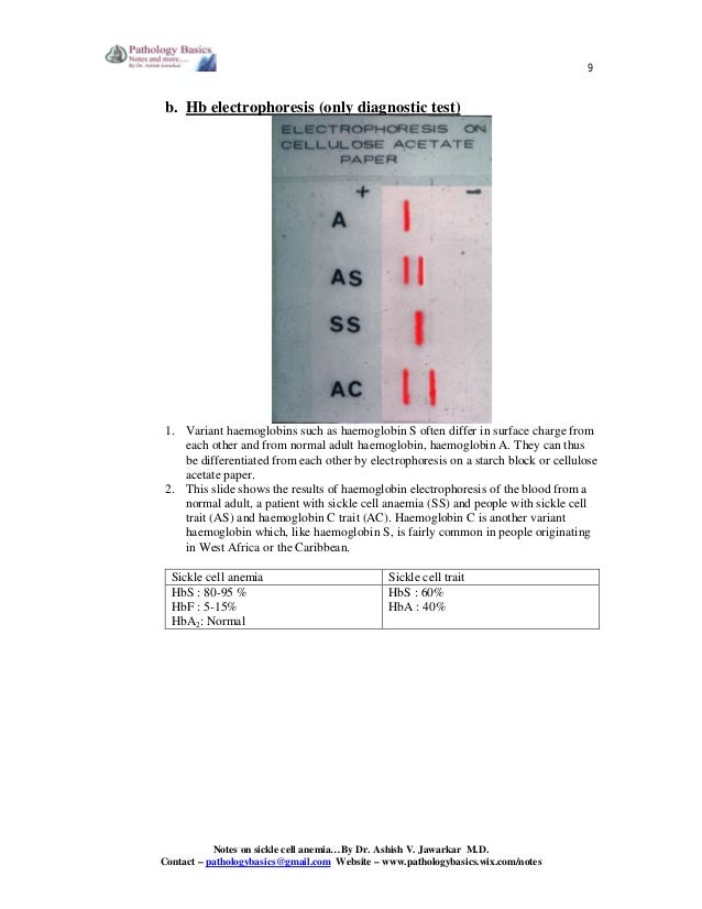 Sickle cell Anemia