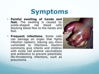 Symptoms
 Painful swelling of hands and
feet. The swelling is caused by
sickle-shaped red blood cells
blocking blood flow to the hands and
feet.
 Frequent infections. Sickle cells
can damage an organ that fights
infection (spleen), leaving you more
vulnerable to infections. Doctors
commonly give infants and children
with sickle cell anemia vaccinations
and antibiotics to prevent potentially
life-threatening infections, such as
pneumonia.
 