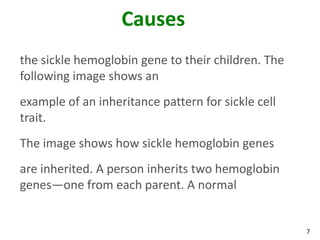 7
Causes
the sickle hemoglobin gene to their children. The
following image shows an
example of an inheritance pattern for sickle cell
trait.
The image shows how sickle hemoglobin genes
are inherited. A person inherits two hemoglobin
genes—one from each parent. A normal
 