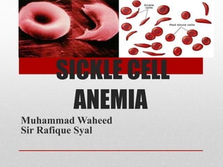 SICKLE CELL
SICKLE CELL
ANEMIA
Muhammad Waheed
Sir Rafique Syal
 
