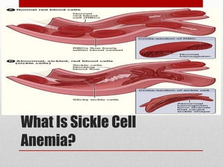 What Is Sickle Cell Anemia? 