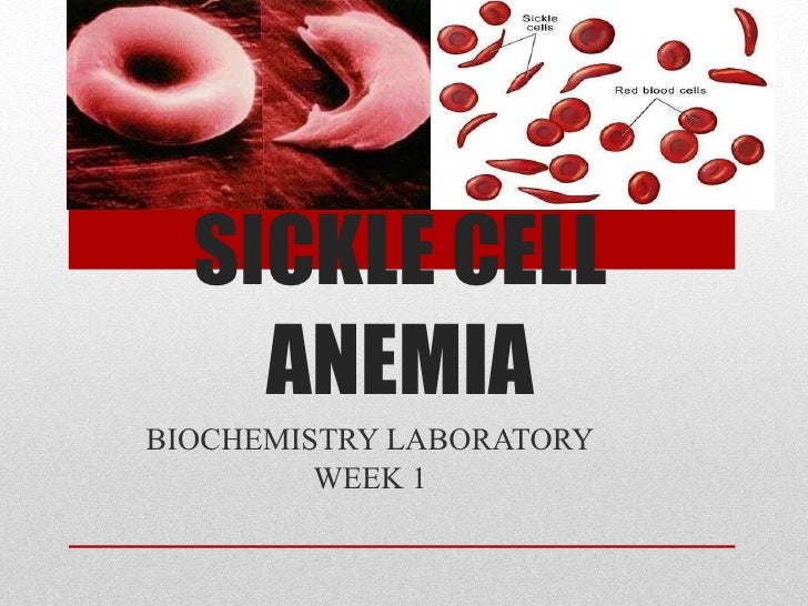 Sickle cell anemia research paper