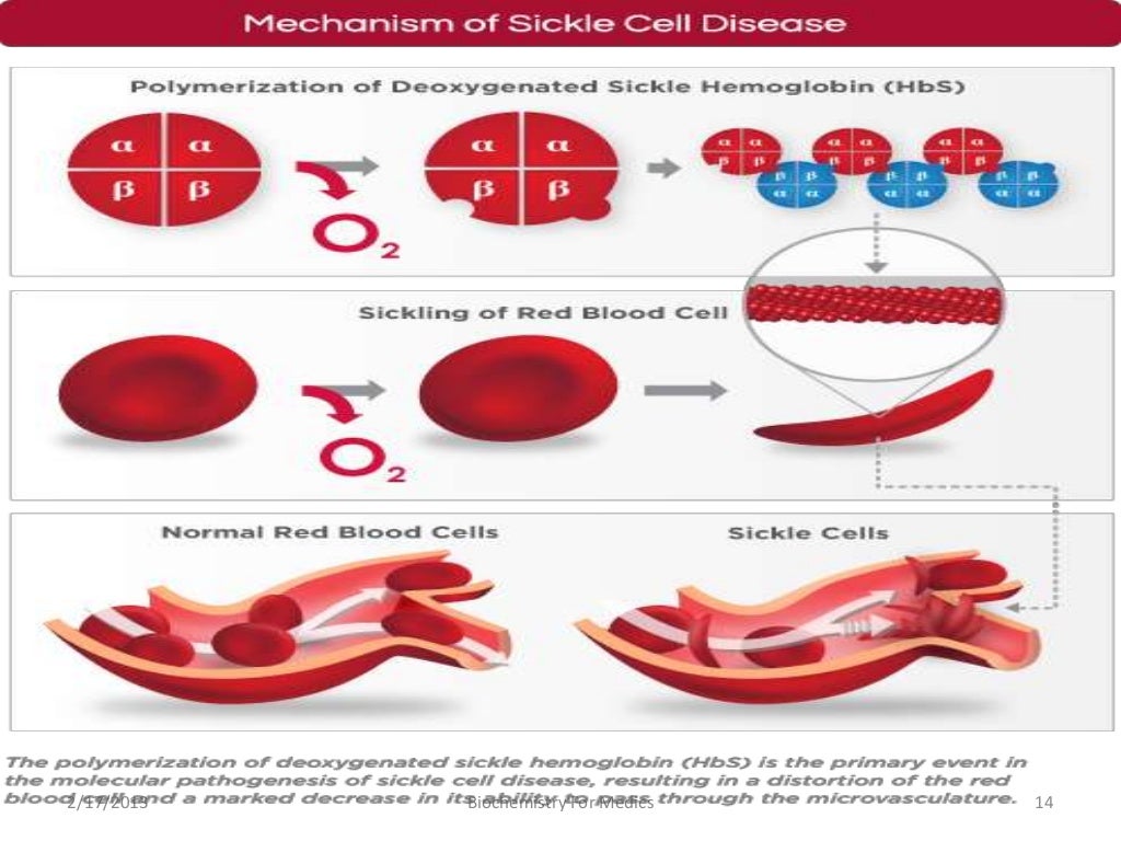 Sickle cell anemia An Overview