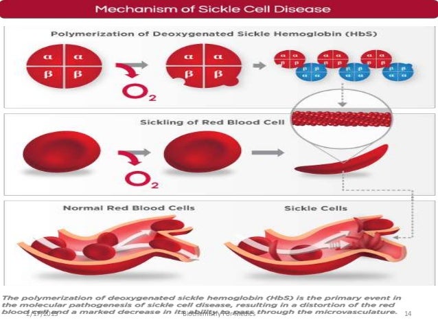 Hemoglobin Disease Sickle cell anemia An Overview
