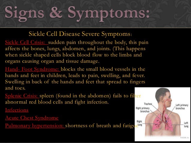 Sickle Cell Anemia