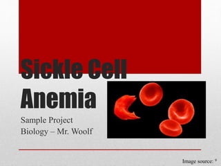 Sickle Cell 
Anemia 
Sample Project 
Biology – Mr. Woolf 
Image source: 9 
 