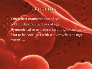  Often first manifestation of sca
 50% of children by 2 yrs of age
 Symmetrical or unilateral swelling of the hands
 Not to be confused with osteomyelitis as mgt
varies….
 