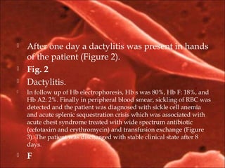  After one day a dactylitis was present in hands
of the patient (Figure 2).
 Fig. 2
 Dactylitis.
 In follow up of Hb electrophoresis, Hb s was 80%, Hb F: 18%, and
Hb A2: 2%. Finally in peripheral blood smear, sickling of RBC was
detected and the patient was diagnosed with sickle cell anemia
and acute splenic sequestration crisis which was associated with
acute chest syndrome treated with wide spectrum antibiotic
(cefotaxim and erythromycin) and transfusion exchange (Figure
3). The patient was discharged with stable clinical state after 8
days.
 F
 