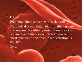  Fig. 3
 Prepheral blood smears with sickle cell.
 The clinical presentation of our patient is rare
and unusual for initial presentation of sickle
cell anemia. Also association between acute
chest syndrome and splenic sequestration is
unusual.
 Go to:
 