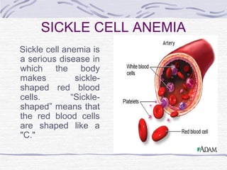 SICKLE CELL ANEMIA
Sickle cell anemia is
a serious disease in
which the body
makes sickle-
shaped red blood
cells. “Sickle-
shaped” means that
the red blood cells
are shaped like a
"C."
 