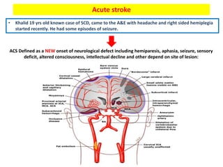 Acute stroke
• Khalid 19 yrs old known case of SCD, came to the A&E with headache and right sided hemiplegia
started recently. He had some episodes of seizure.
ACS Defined as a NEW onset of neurological defect including hemiparesis, aphasia, seizure, sensory
deficit, altered consciousness, intellectual decline and other depend on site of lesion:
 
