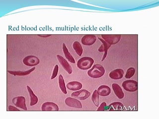 Red blood cells, multiple sickle cells
 